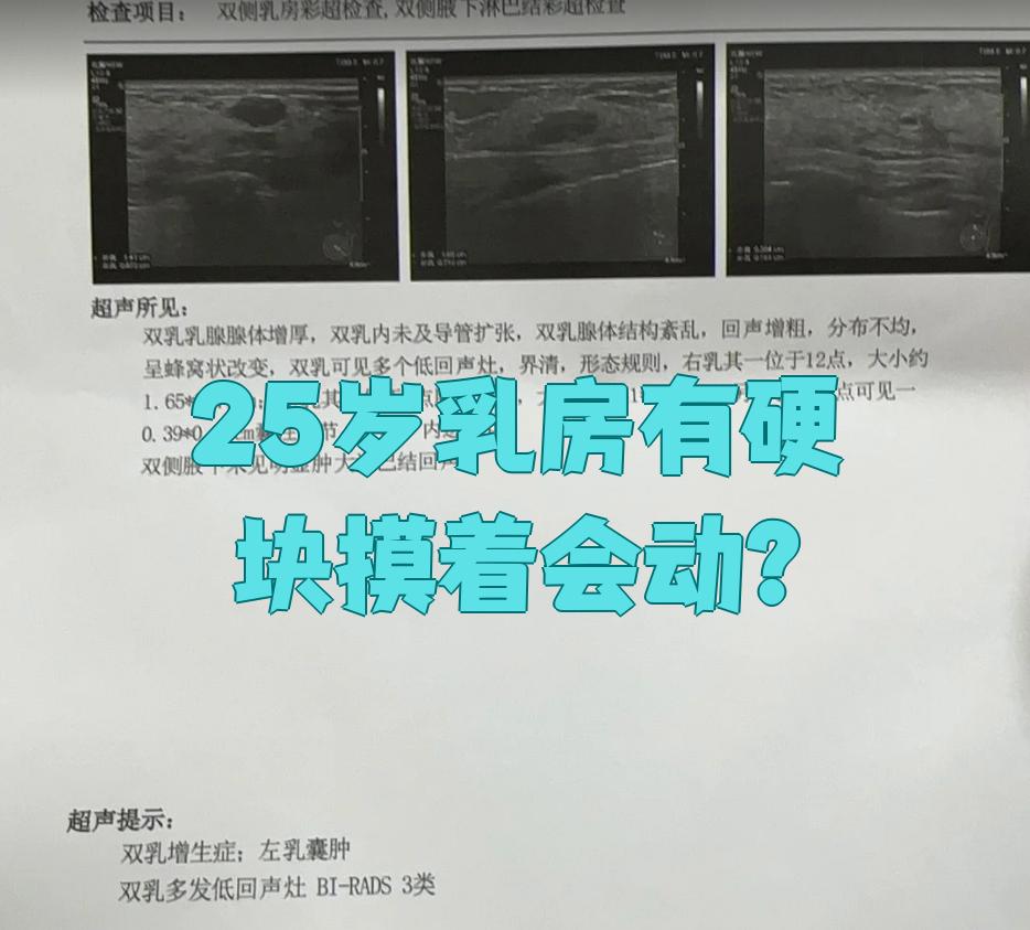 乳腺腺纤维瘤会癌变吗