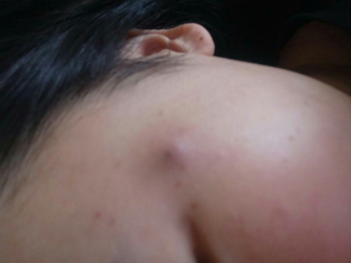 脸上长了个大脓包