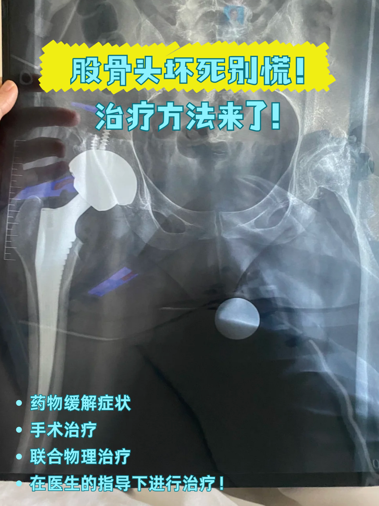 股骨头坏死该怎么治疗