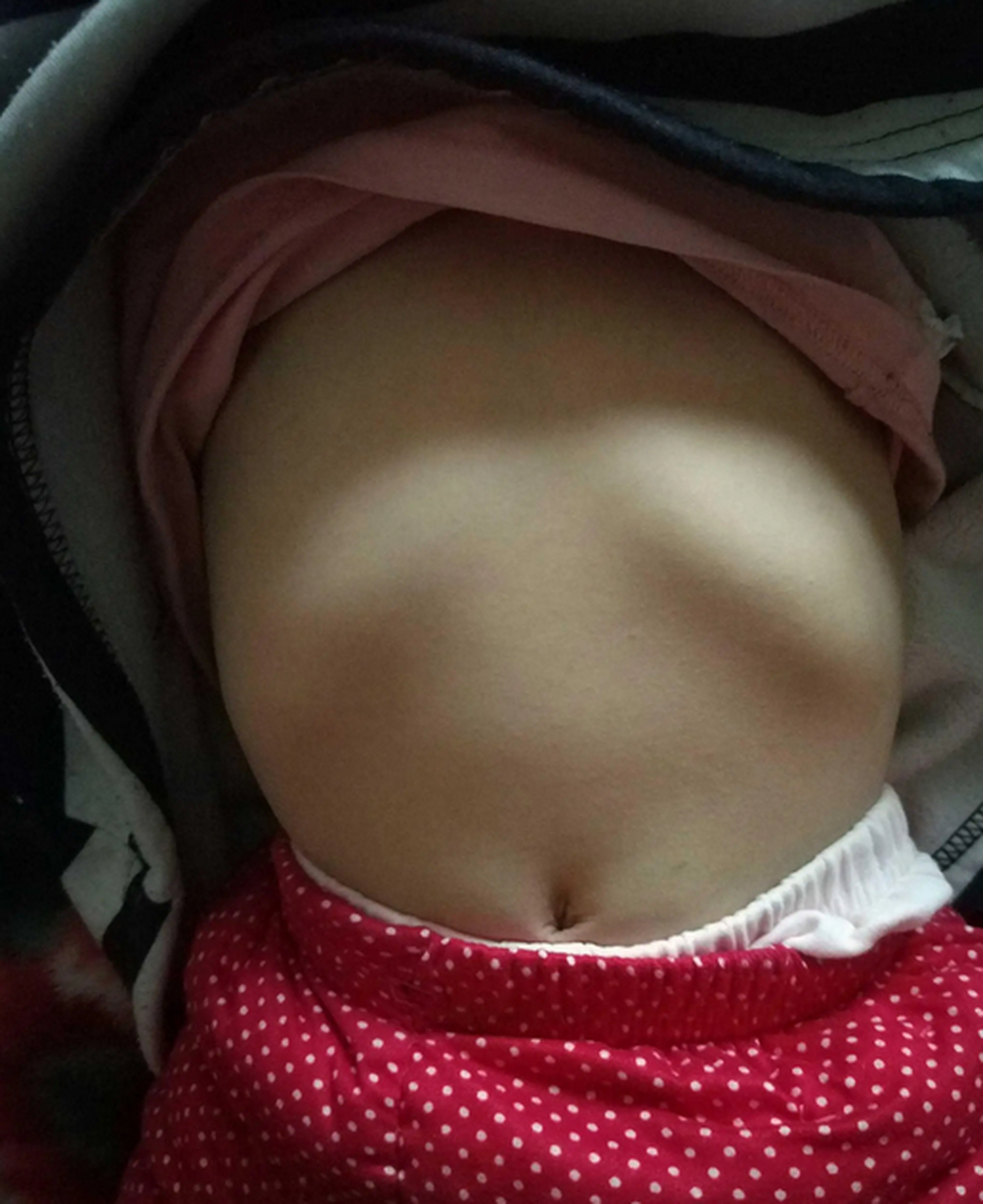 平躺肋骨凸出正常吗?
