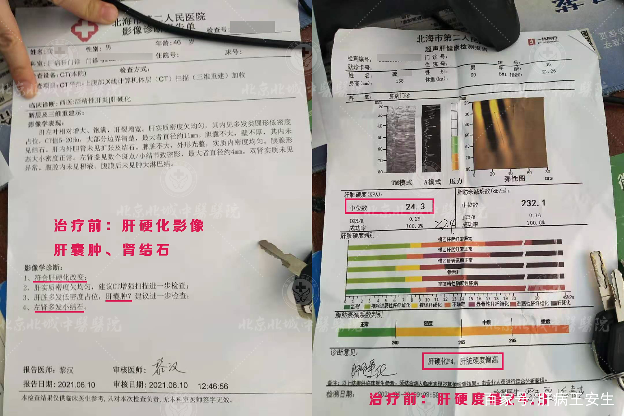 肾结石微创手术几天后可以康复