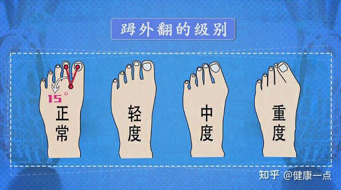 什么是拇外翻