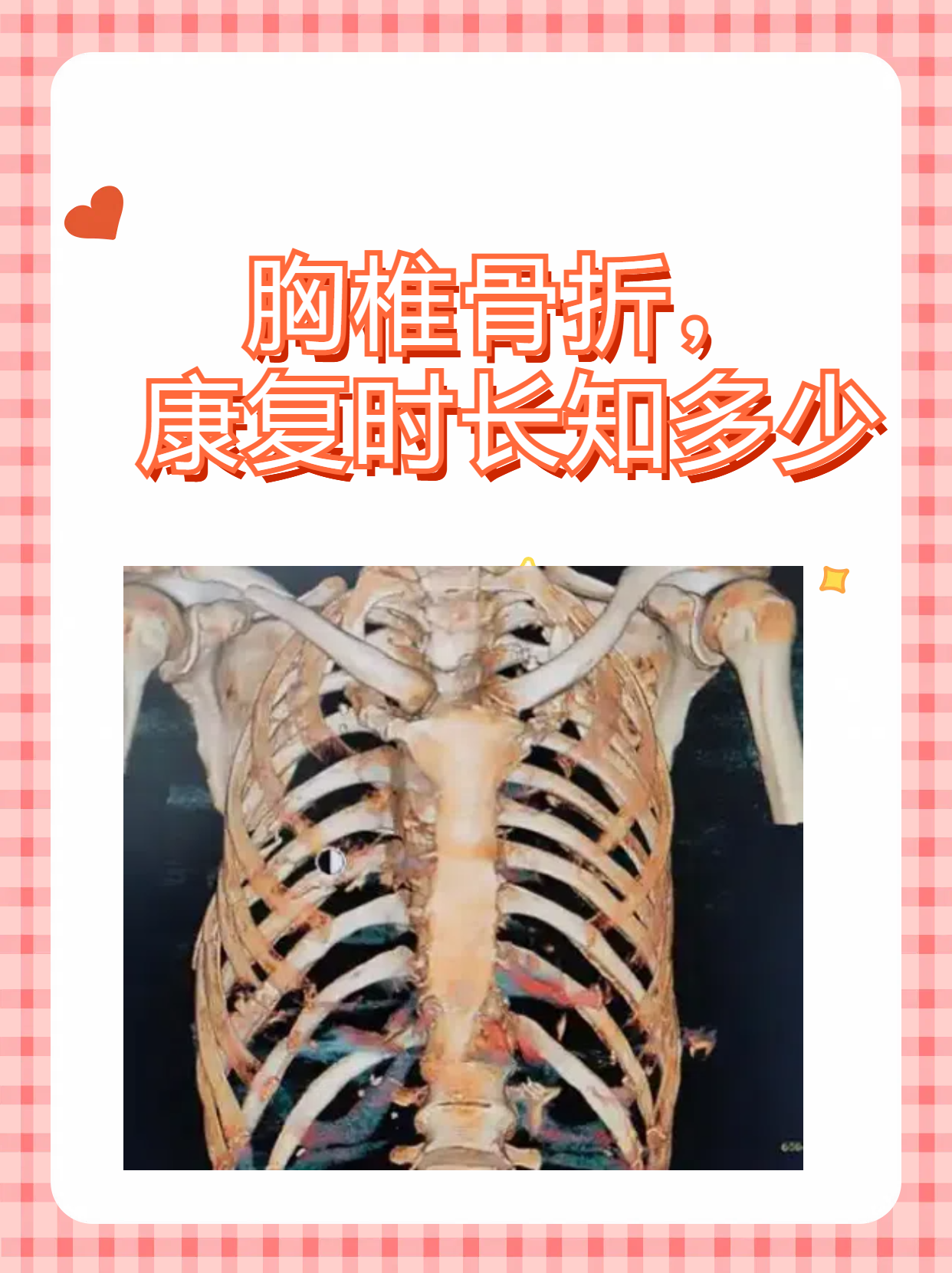 胸骨突出怎么办?怎么判断自己是否正常?