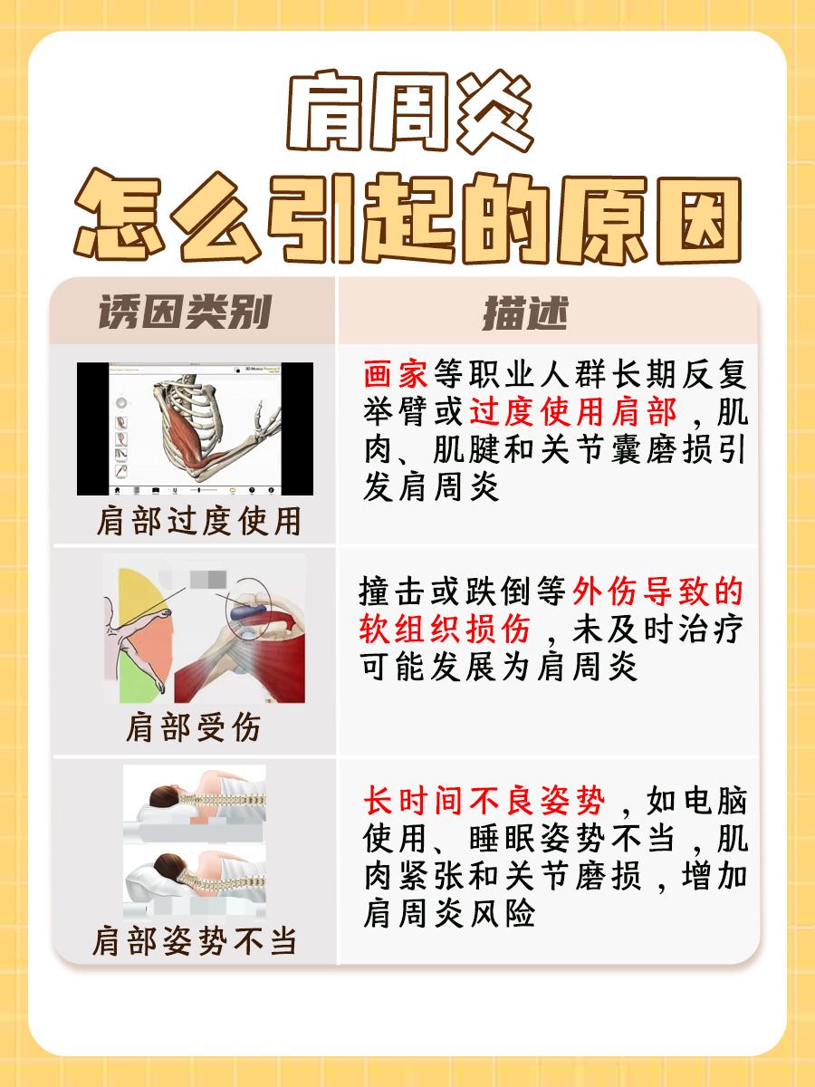 什么是肩周炎