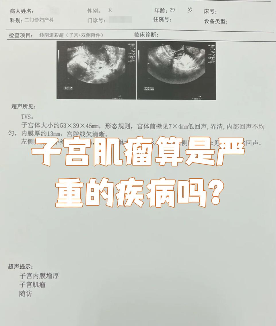 浆膜下子宫肌瘤严重吗
