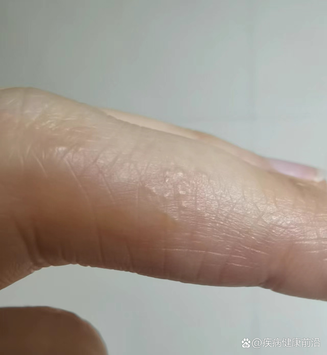 什么是汗疱症