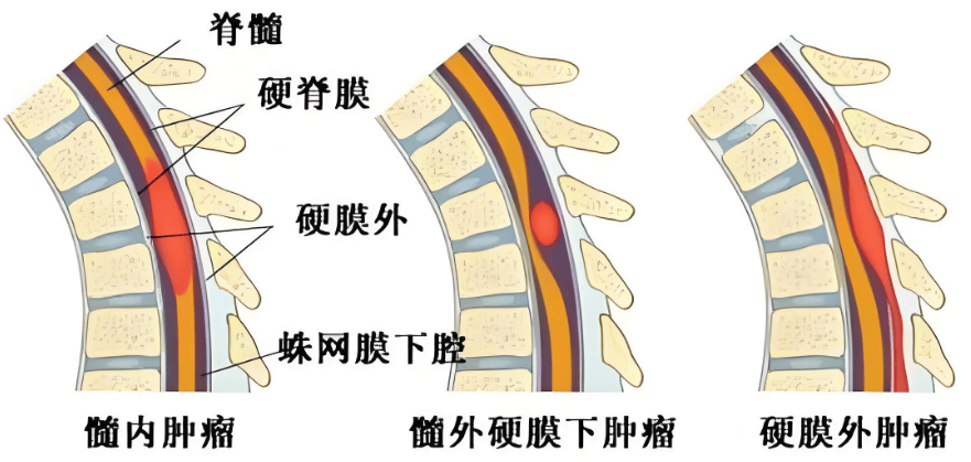 脊髓瘤怎么治疗