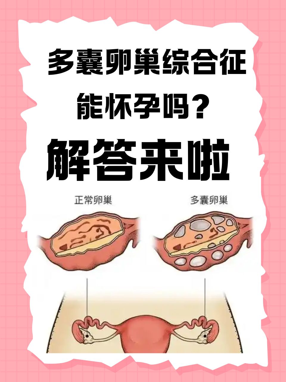 多卵巢综合症是什么病