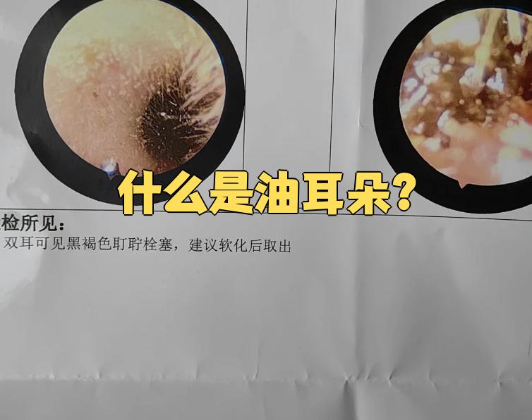 耳朵里有异味,耳屎是湿的