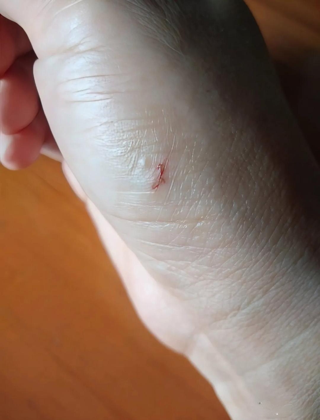 被老鼠咬了出血怎么办