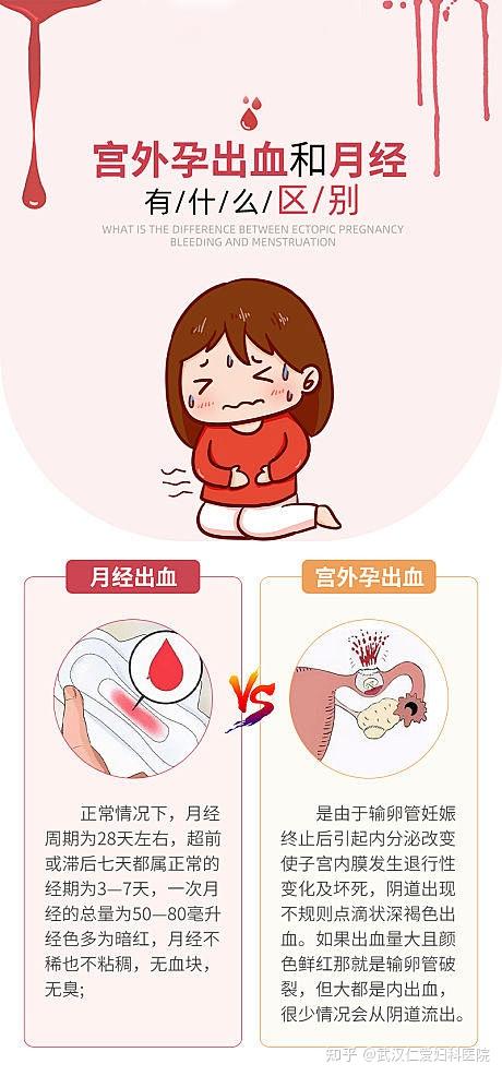 宫外孕早期的症状表现