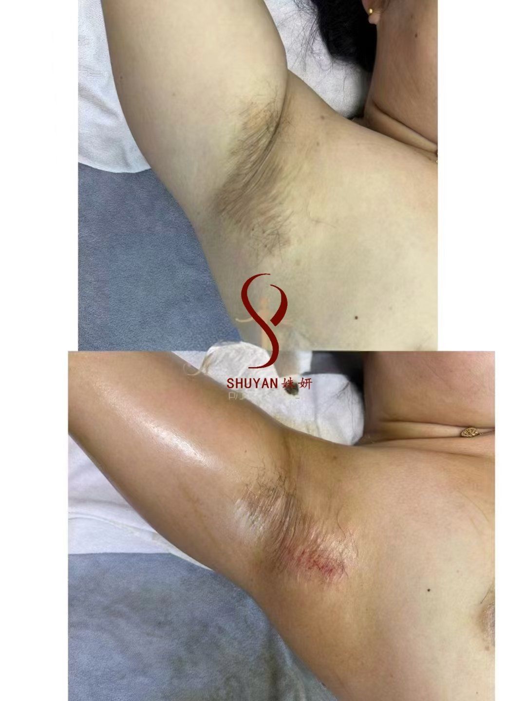 腋下的副乳怎么去除