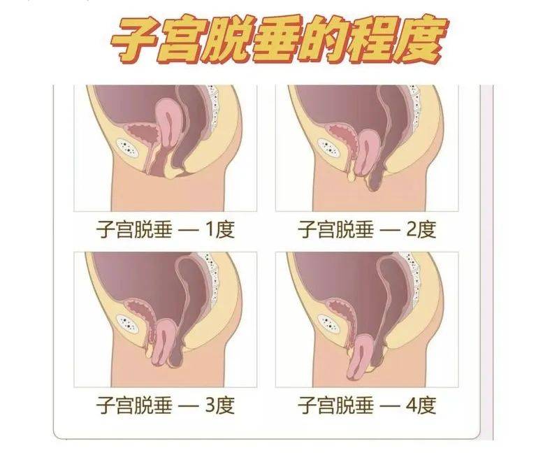子宫下垂能看到吗?这个图片能看清吗?