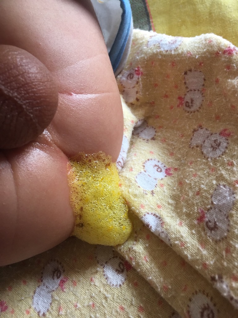 宝宝拉泡沫是怎么回事?