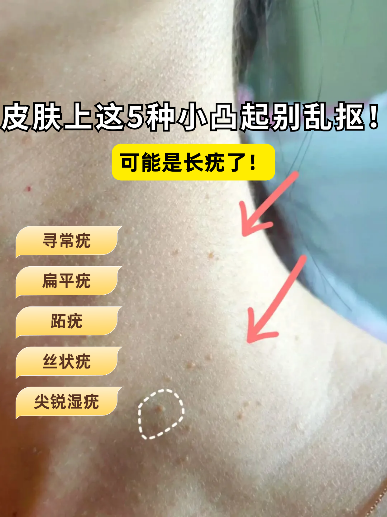 寻常疣会传染给别人吗