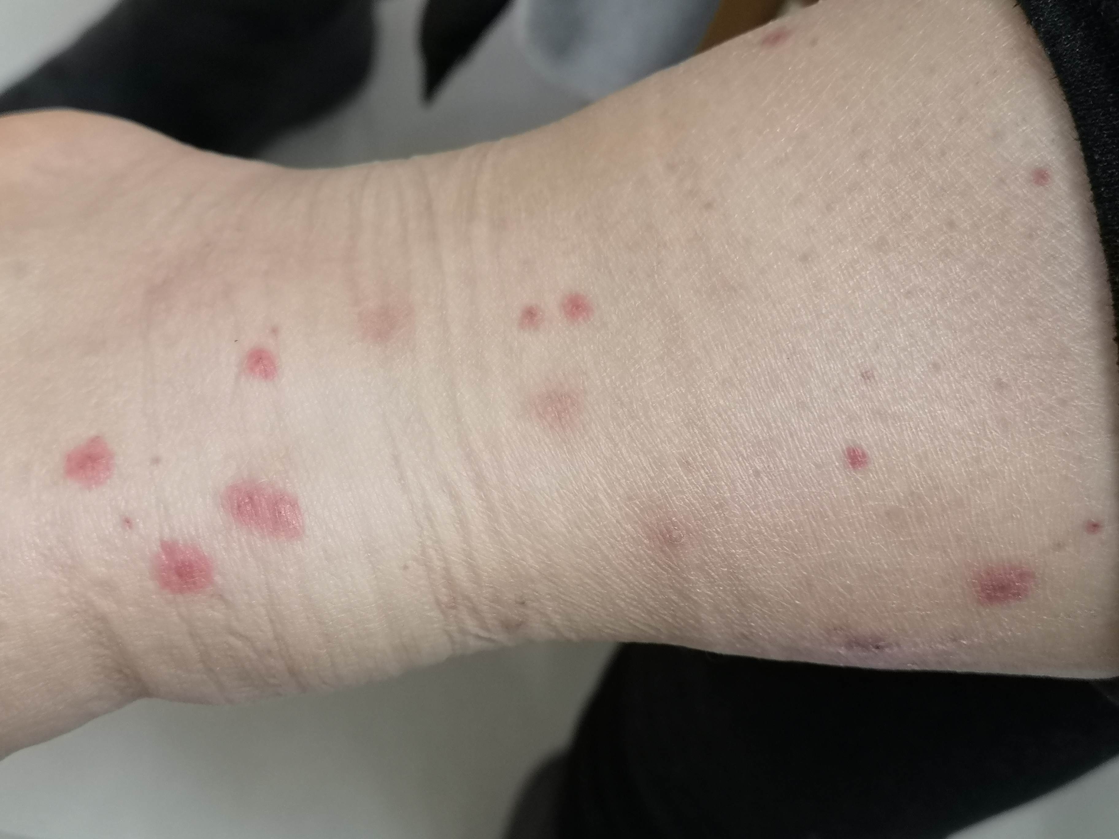 过敏性紫癜一般多长时间可以治好