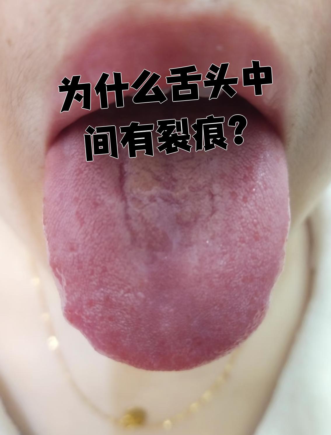 舌头上有裂纹是怎么回事