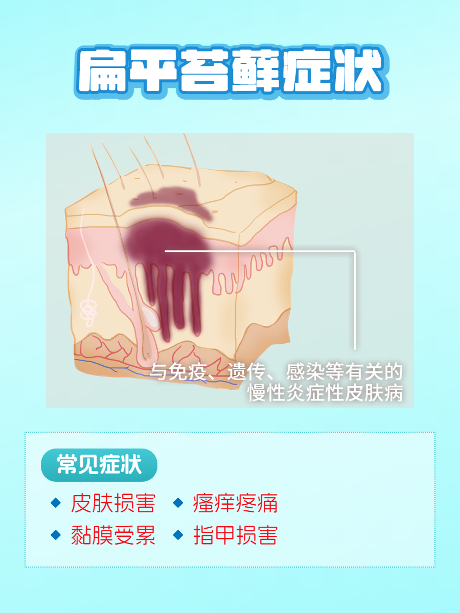 扁平苔癣怎么治疗