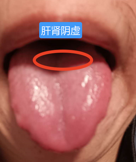 肺阴虚的症状有哪些