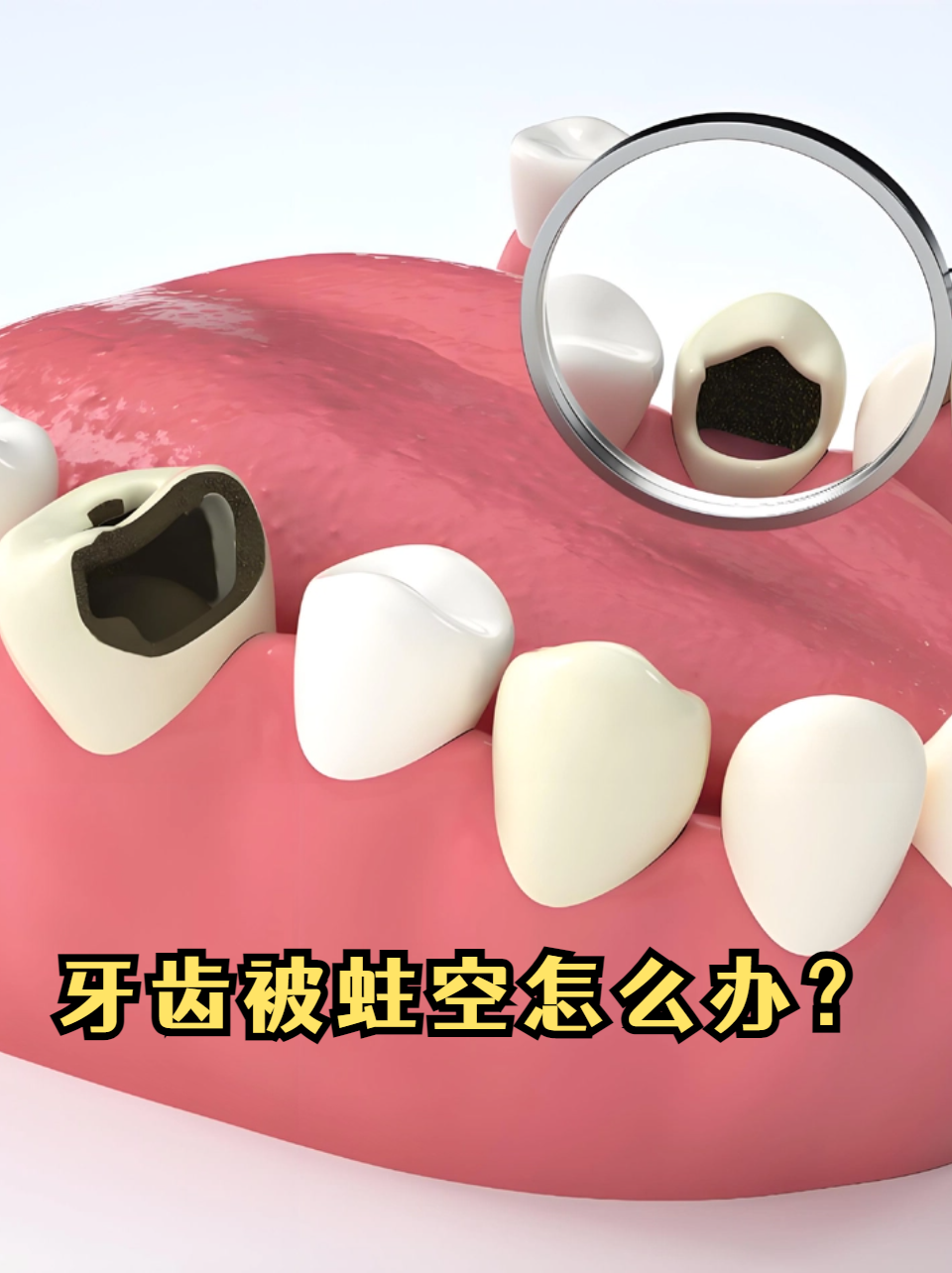 蛀牙只剩牙根需要拔掉吗