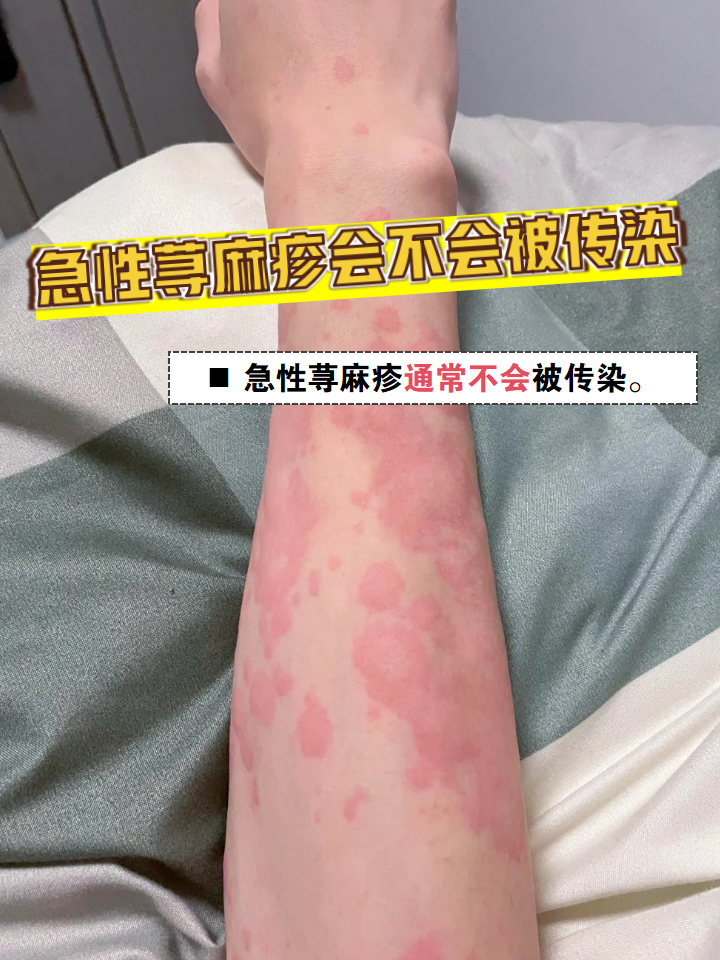 荨麻疹会传染吗