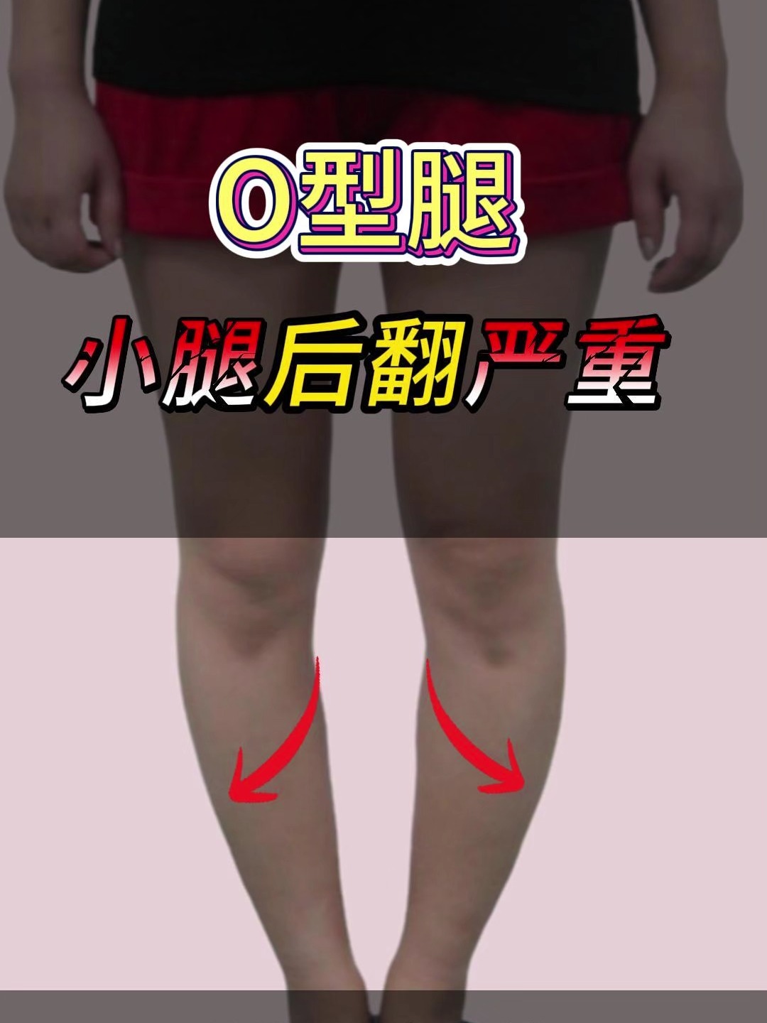 O型腿怎么办