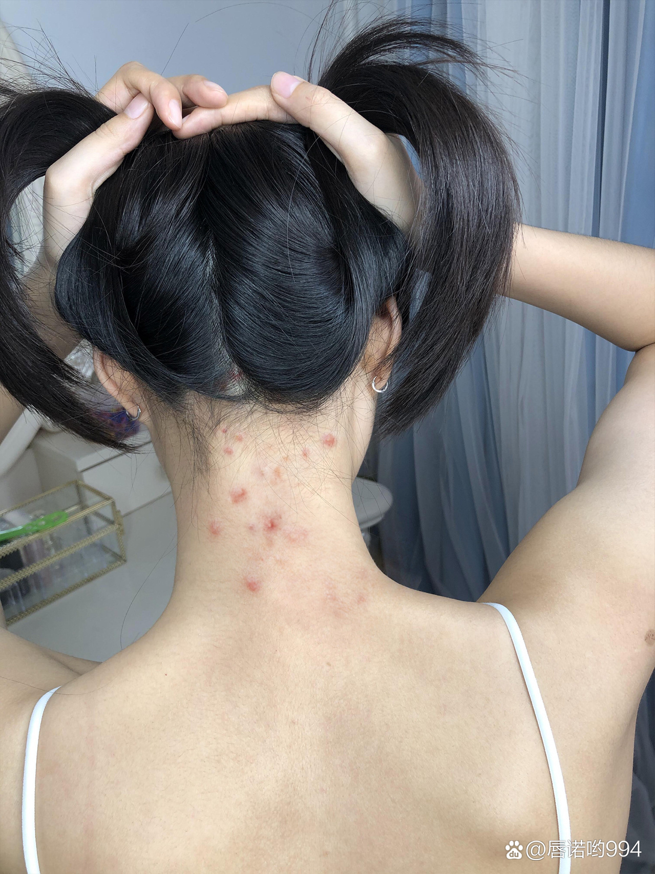 脖颈长痘痘什么原因