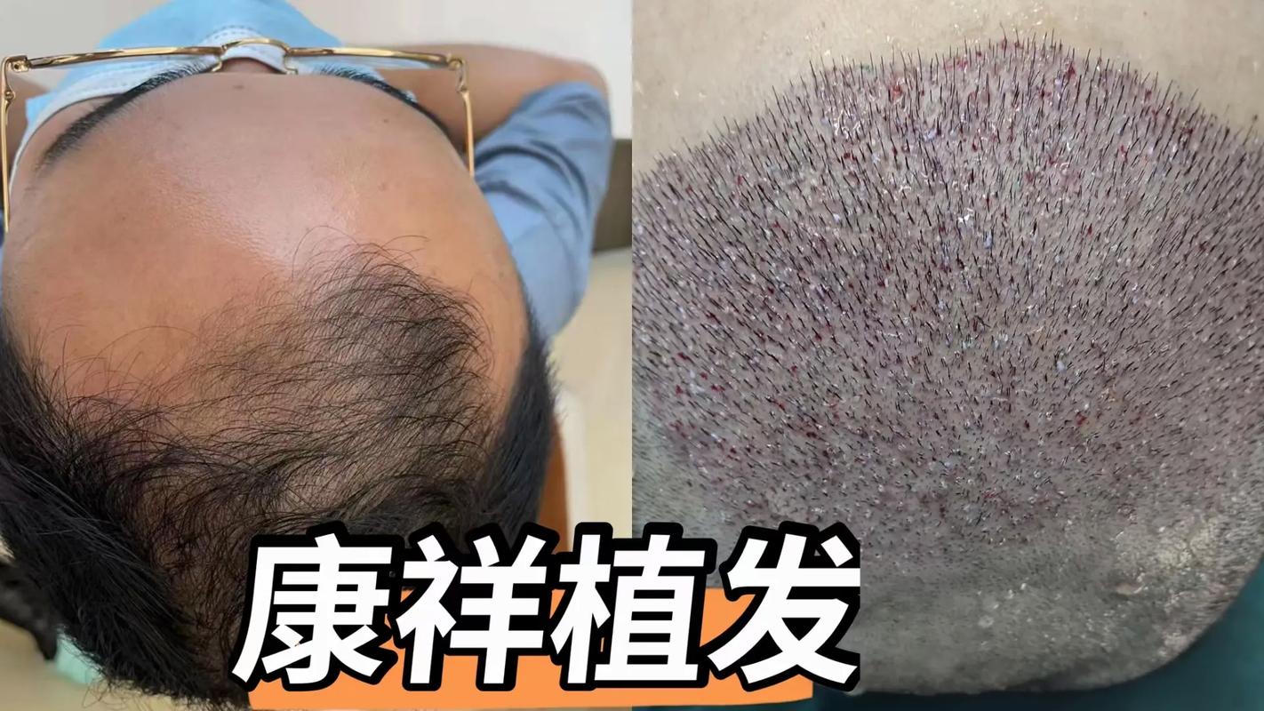 1000个毛囊植发的价格