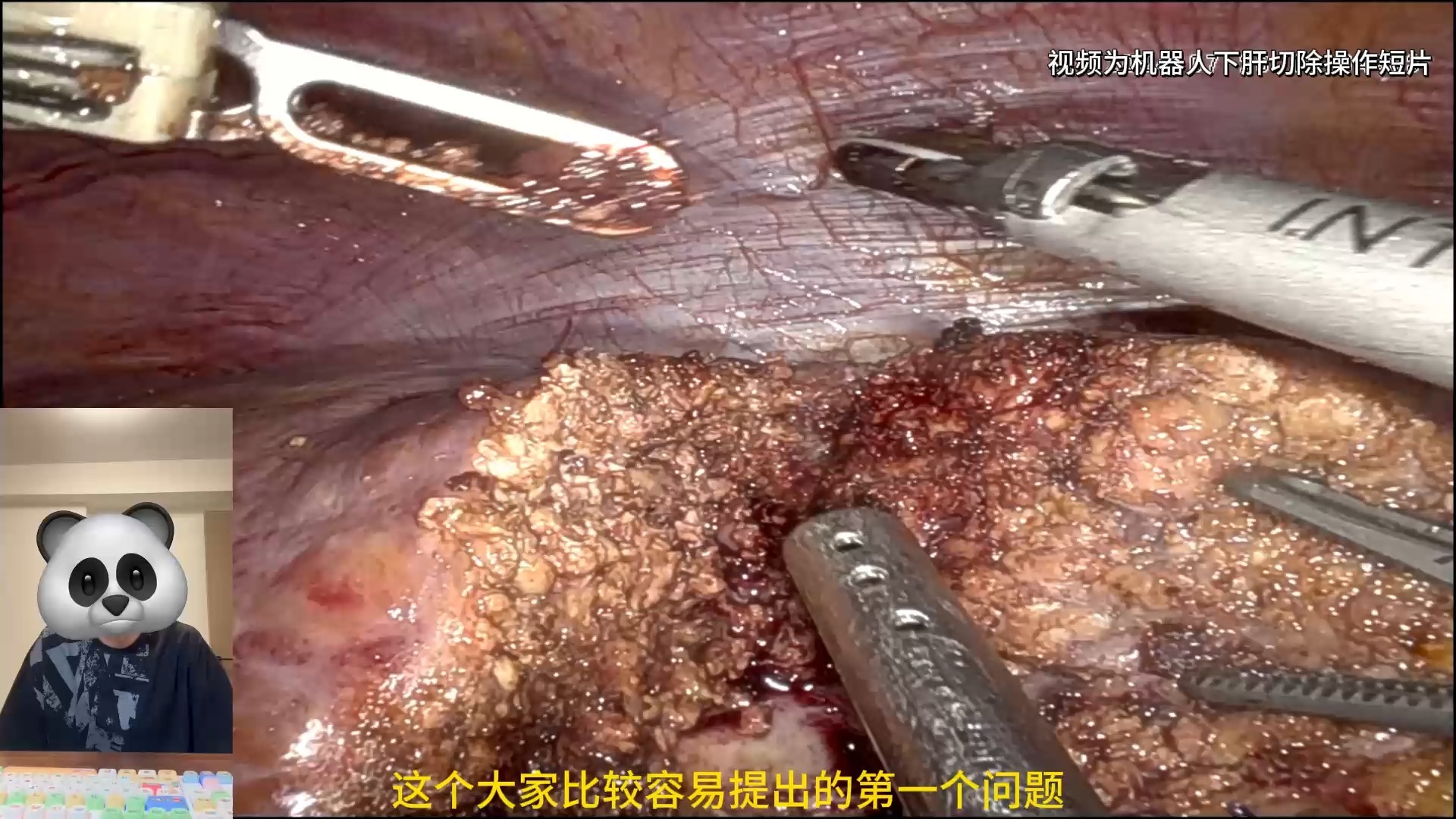 肝脏恶性肿瘤能活多久