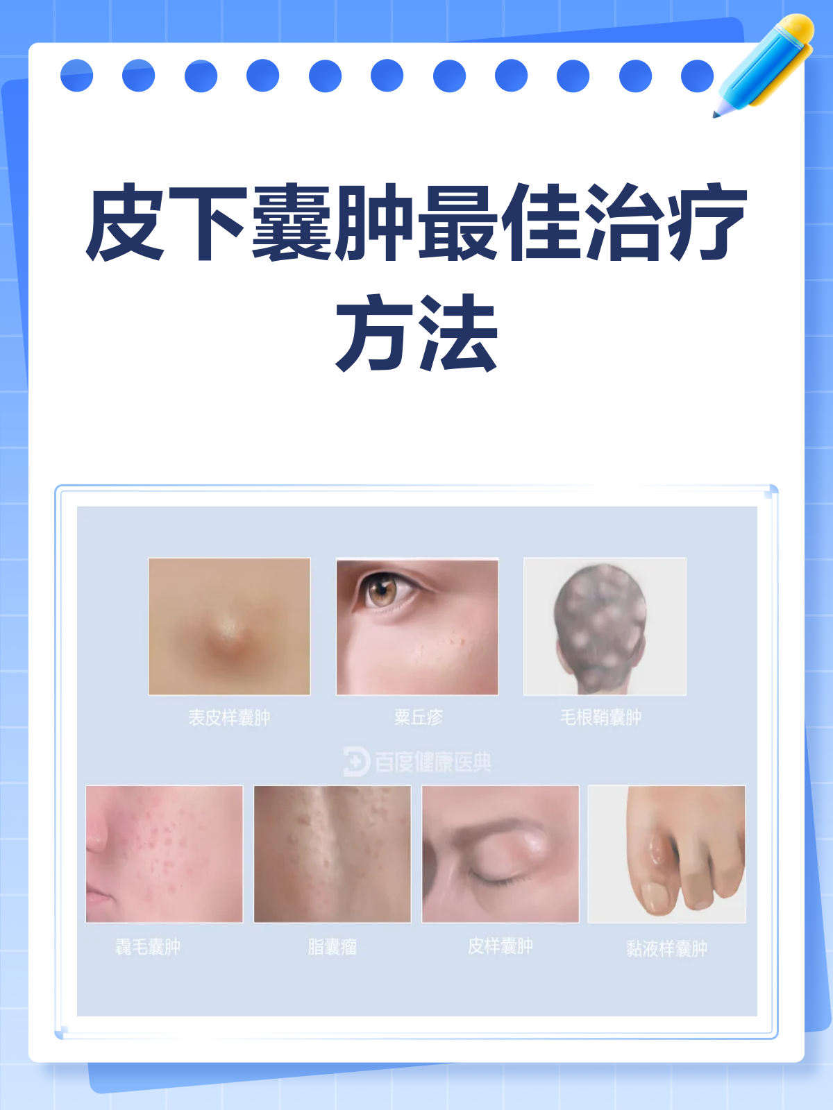 青春痘囊肿怎么治疗