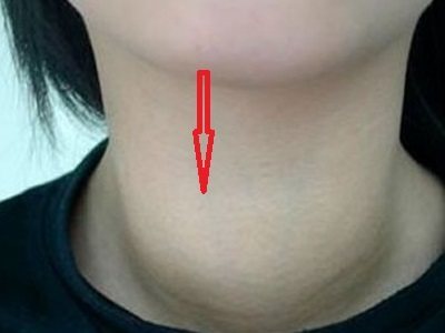 慢性淋巴细胞性甲状腺炎严重吗?
