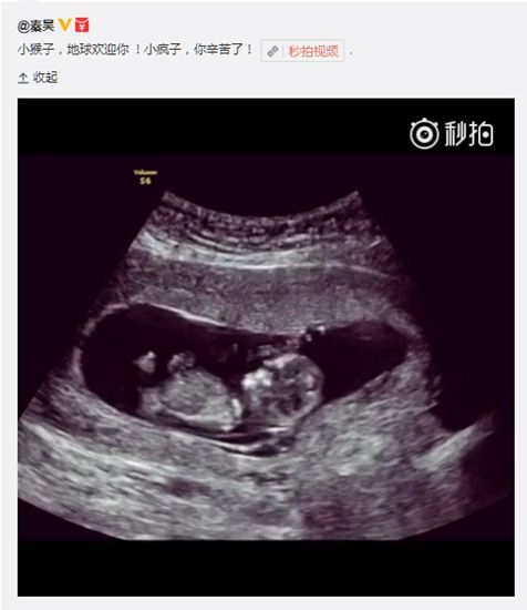 从B超单上怎么鉴别胎儿性别