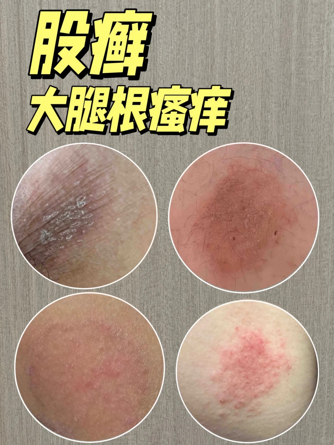 皮肤瘙痒是湿气重吗