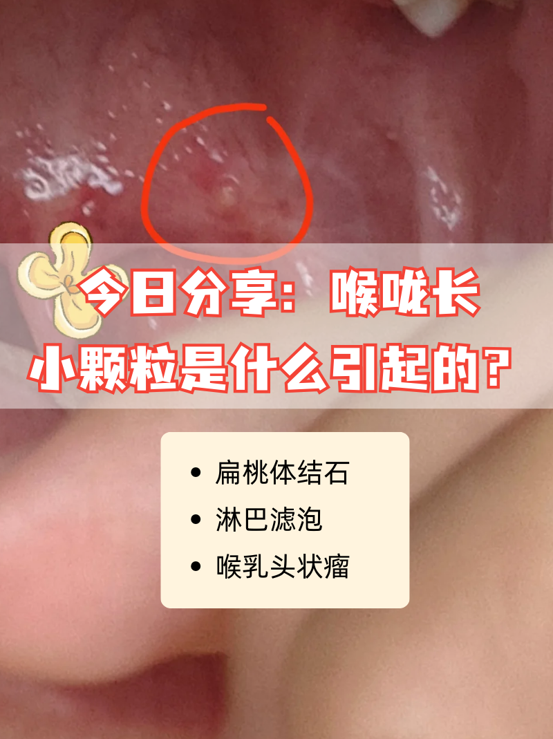 喉咙有小红疙瘩没有感觉