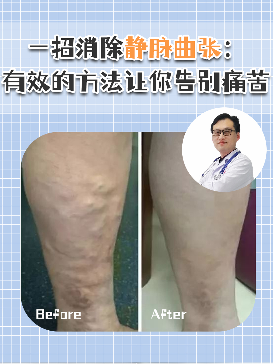 如何有效的治疗静脉曲张