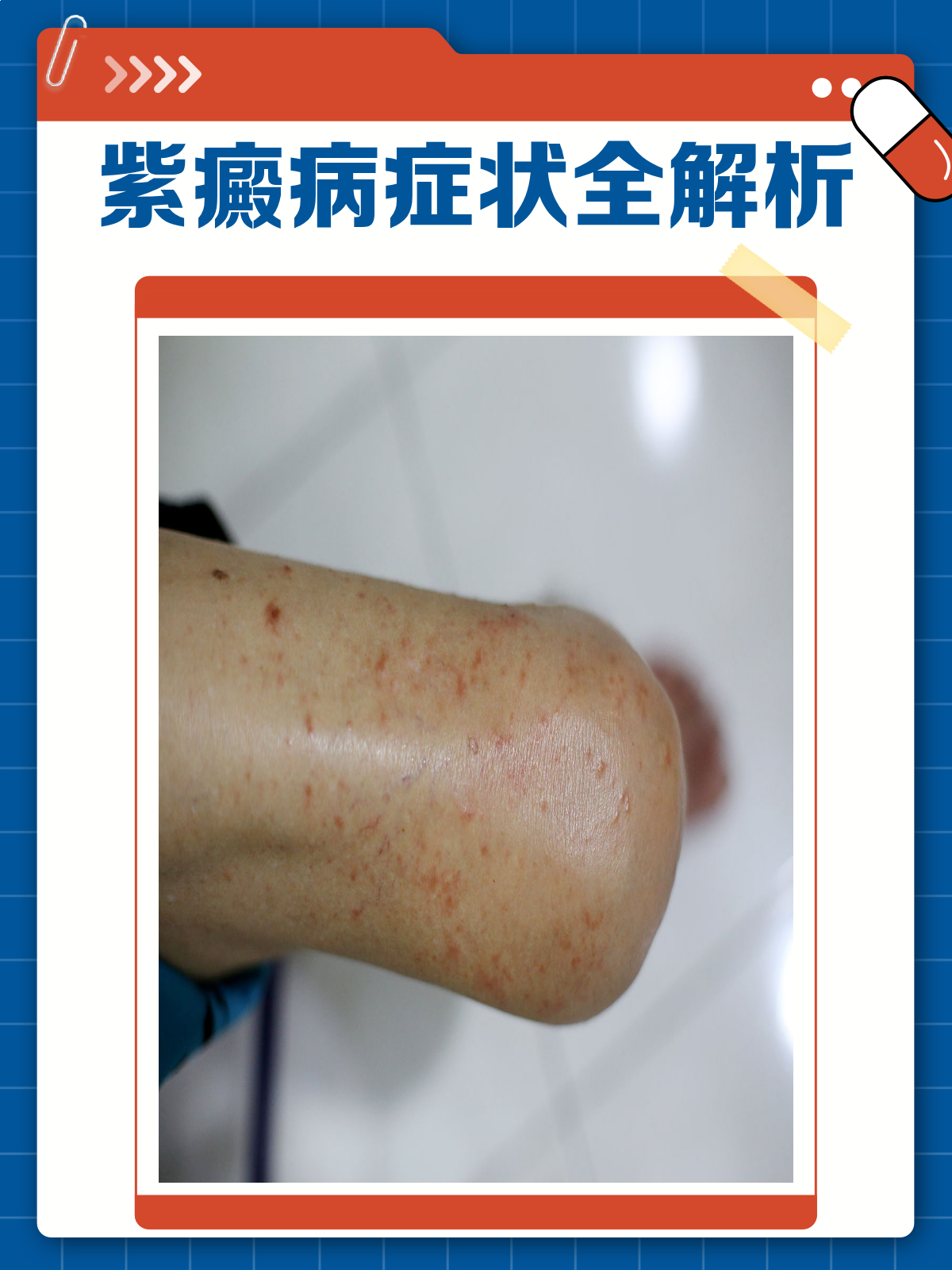 过敏性紫癜是什么回事