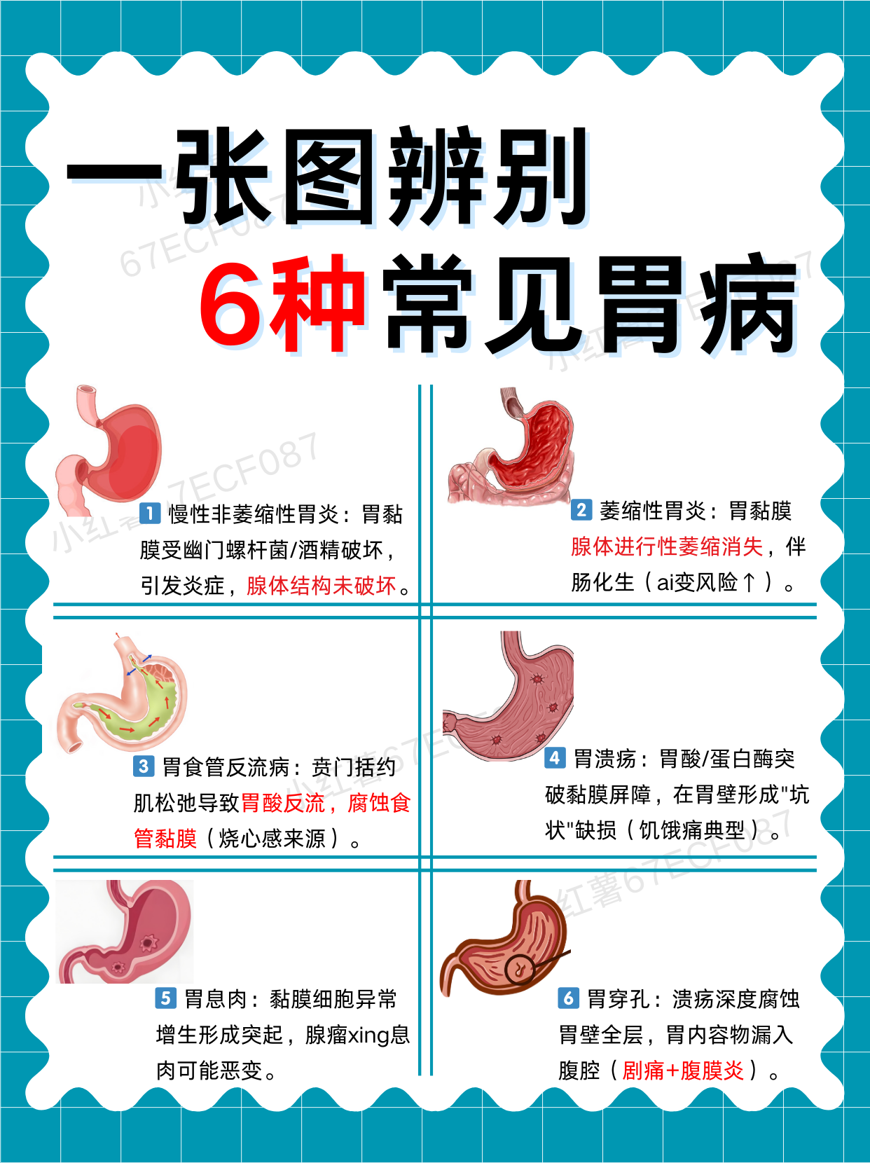 胃溃疡的症状有哪些表现
