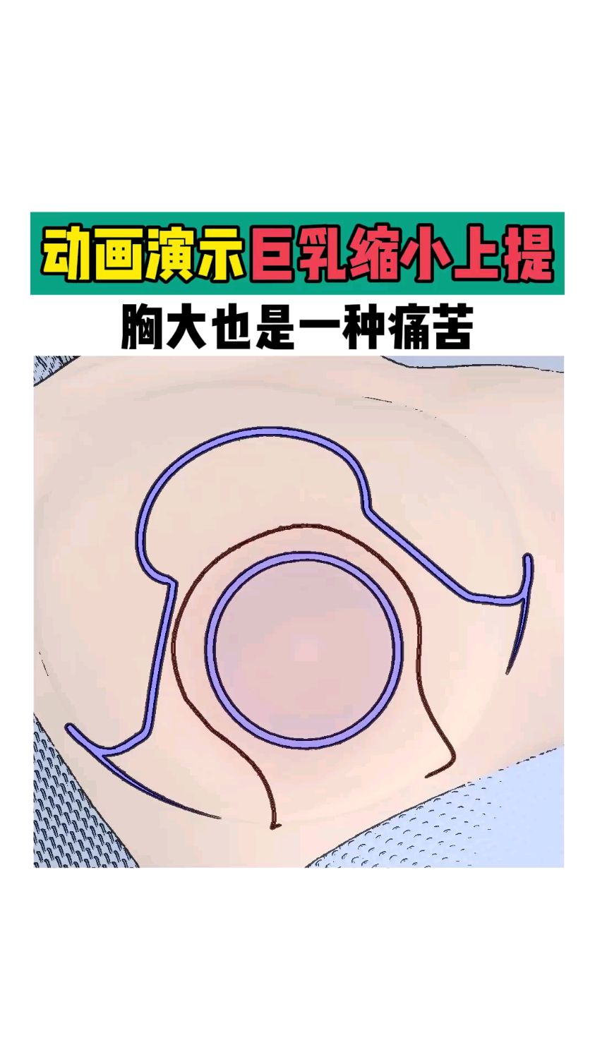 乳房扁平怎么办