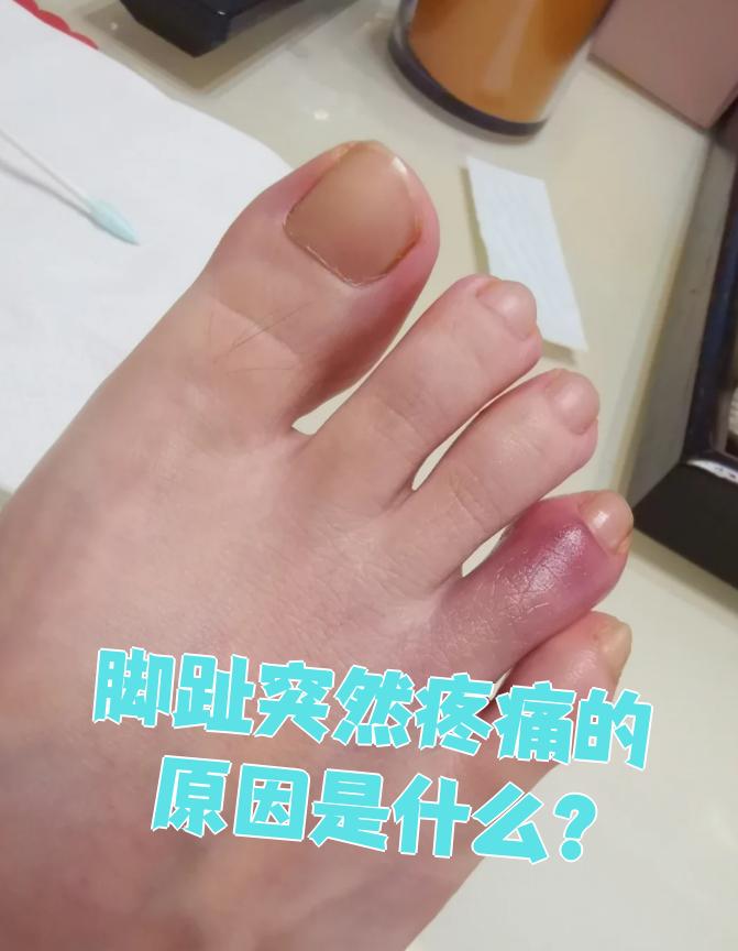急性痛风性关节炎特点?
