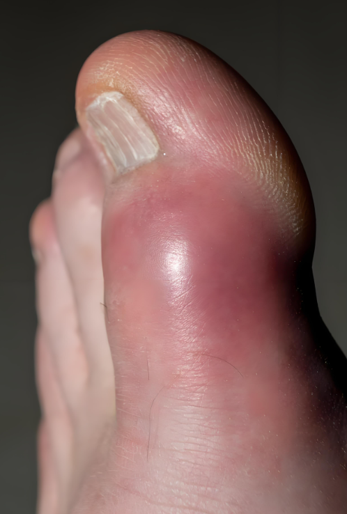 脚趾突然肿起来,痒疼