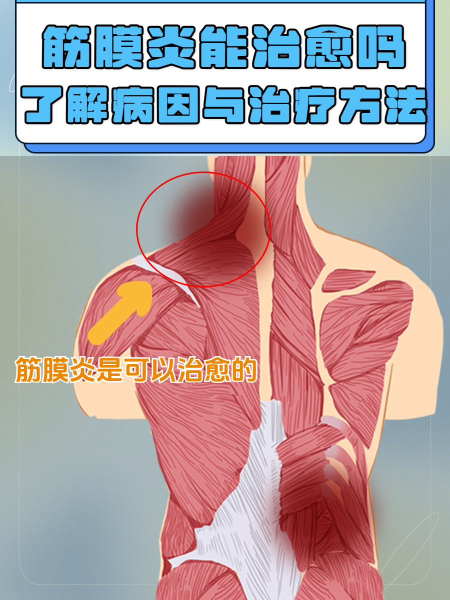 肌筋膜炎的症状