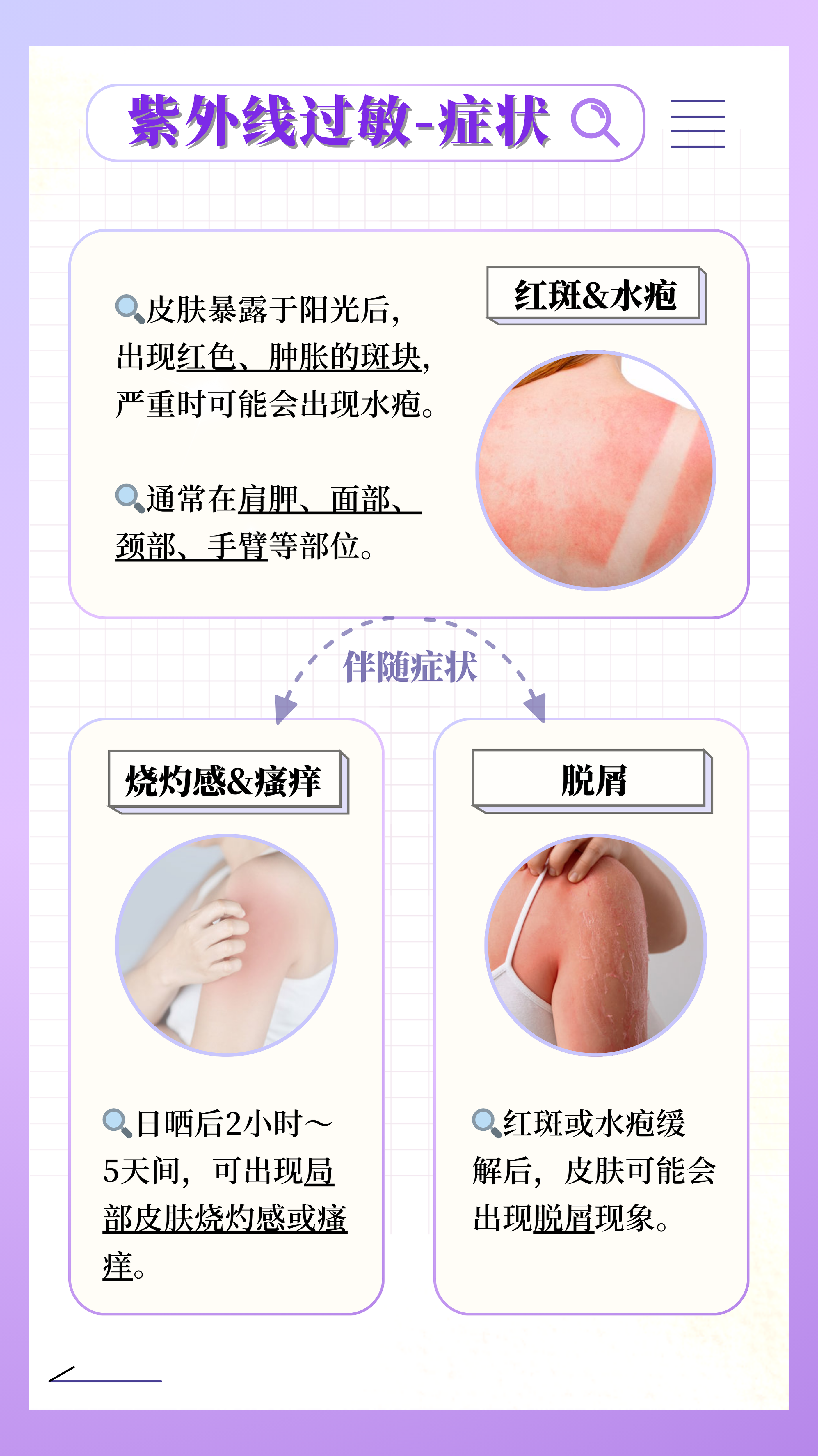 脸部紫外线过敏该怎么办