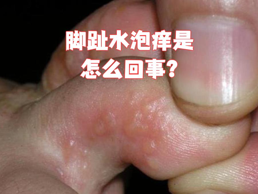 脚上起小水泡是怎么回事