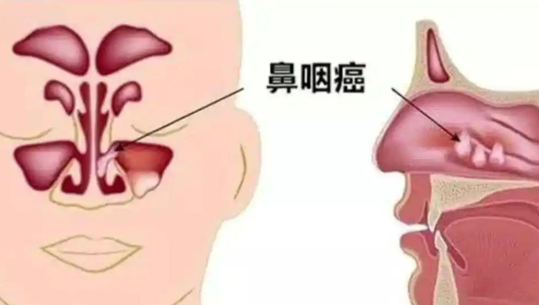 鼻癌的症状有哪些怎么知道自己有鼻癌