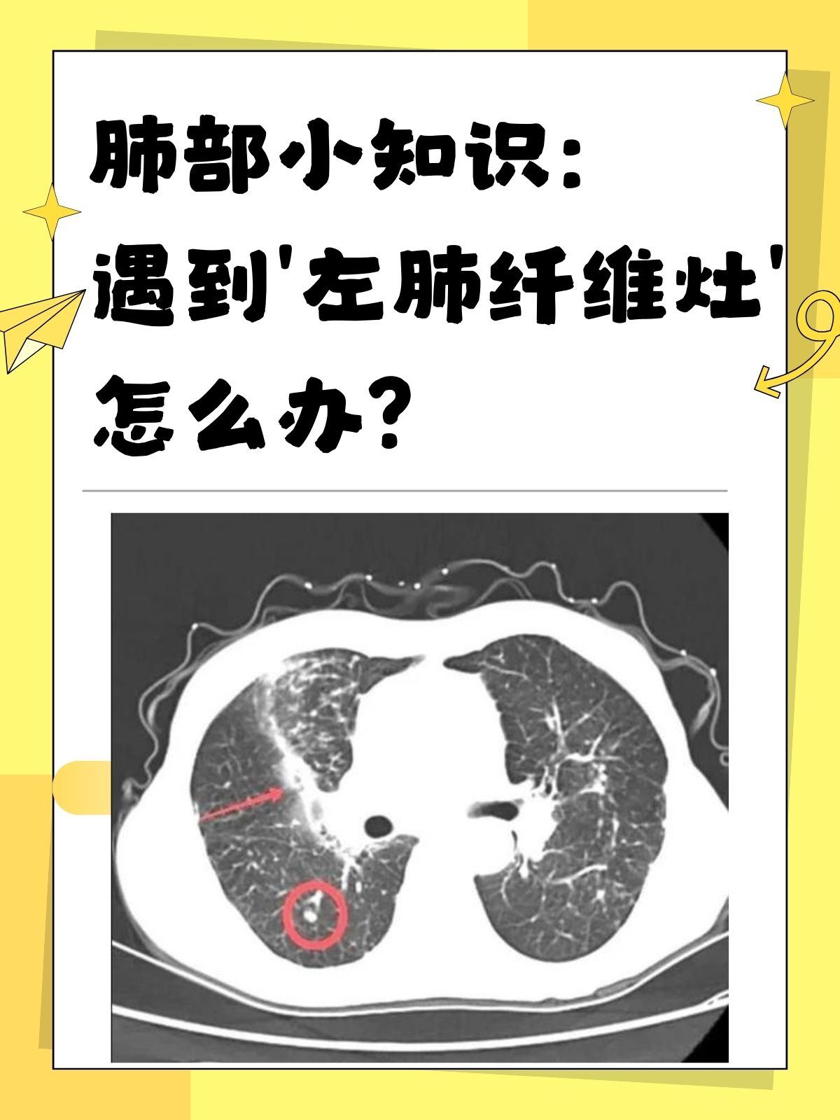 双肺多发纤维灶是什么意思?