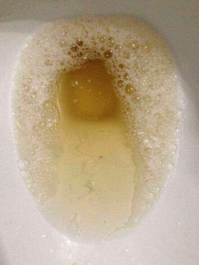 糖尿病患者的尿是甜的吗
