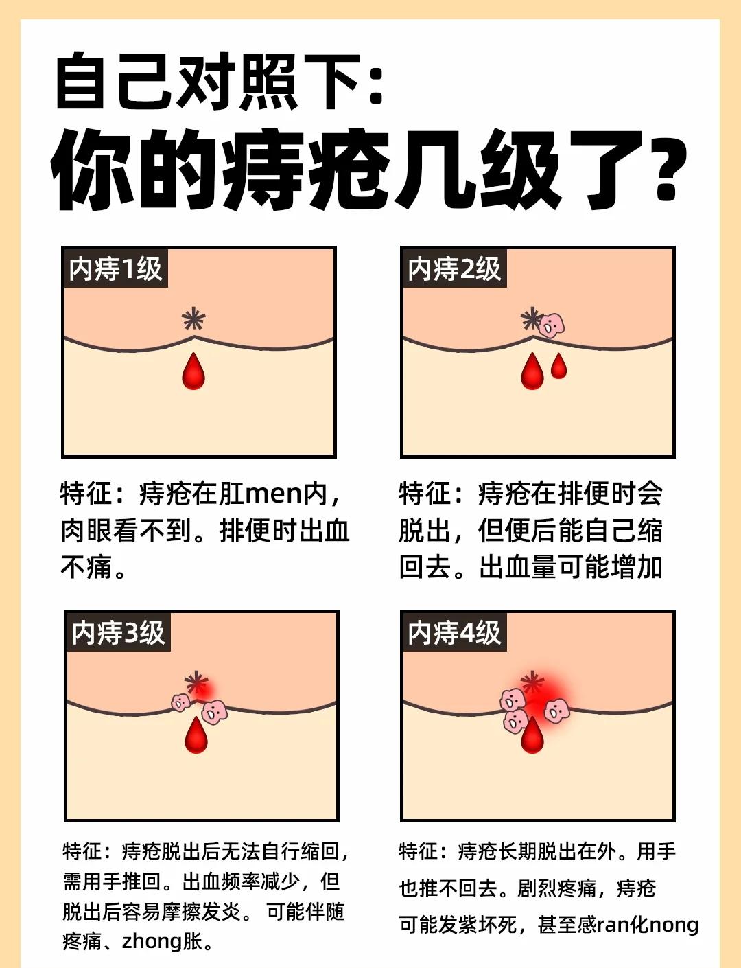 轻微痔疮怎么治疗好?