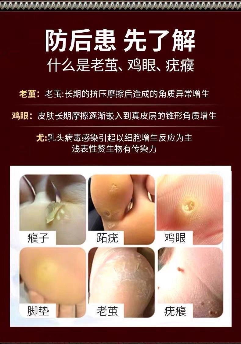 如何治疗鸡眼