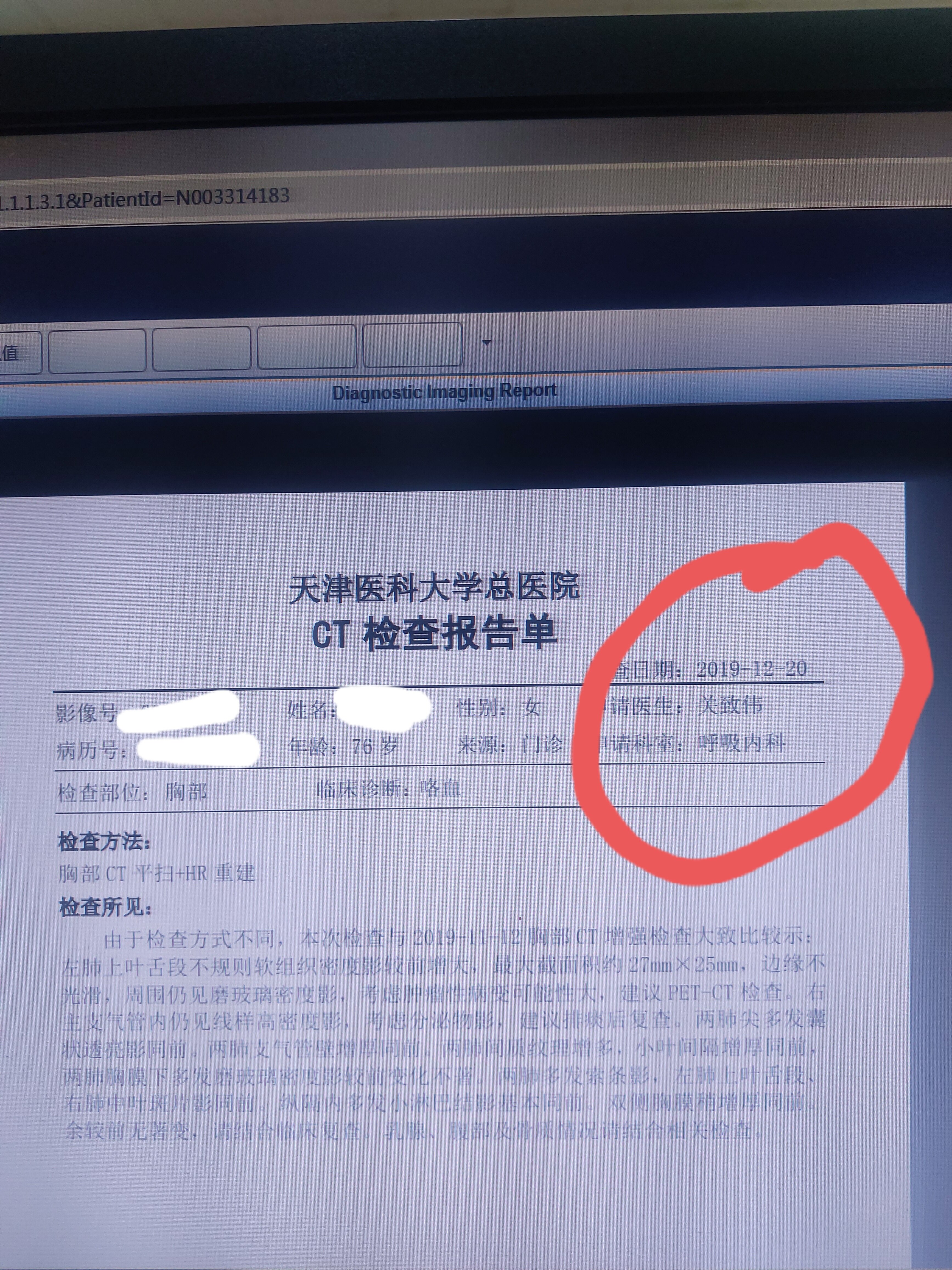 肺CA是什么意思