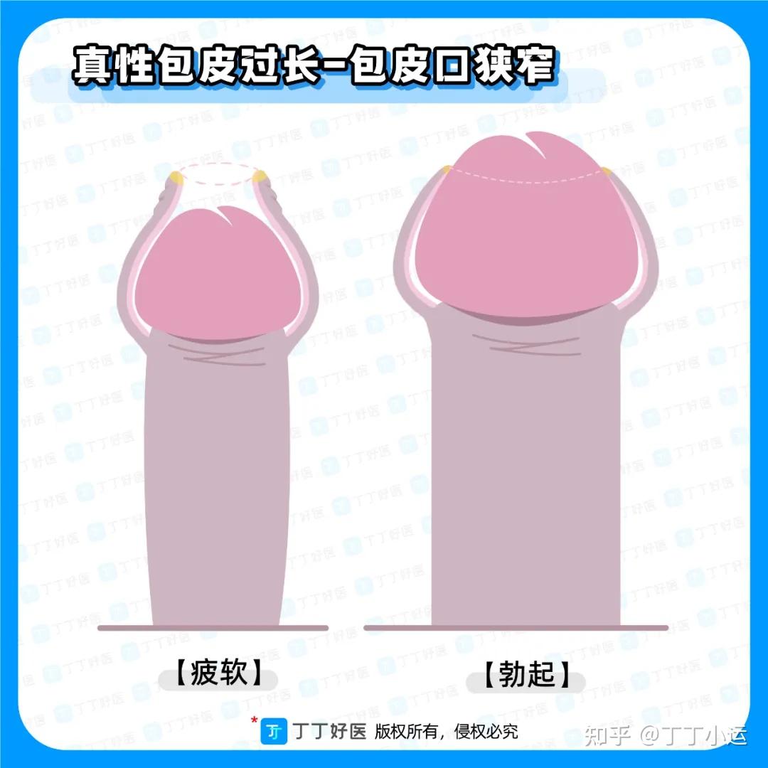 什么样属于包皮